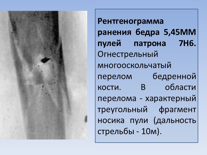 Рентгенограмма ранения бедра 5,45MM пулей патрона 7Н6. Огнестрельный многооскольчатый перелом бедренной кости. В области
